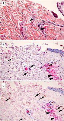 Myeloperoxydase and CD15 With Glycophorin C Double Staining in the Evaluation of Skin Wound Vitality in Forensic Practice